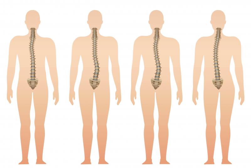 Freepik: A curvatura pode ocorrer para qualquer lado ou em qualquer posição da coluna vertebral
