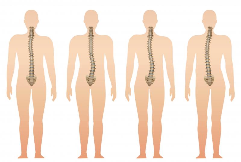 Freepik: A curvatura pode ocorrer para qualquer lado ou em qualquer posição da coluna vertebral
