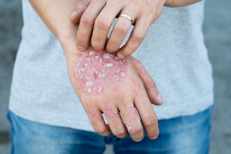 Shutterstock - Psoríase é uma doença crônica da pele e não contagiosa