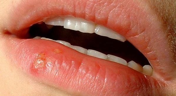Herpes labial pode ser contraído através do beijo, gotículas de saliva, compartilhamento de fômites