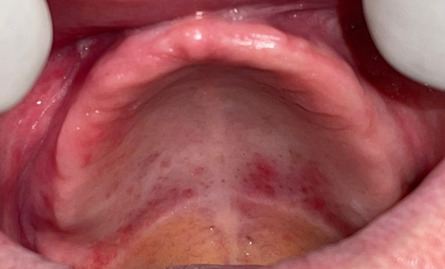 Áreas avermelhadas na mucosa que serve de apoio para a dentadura podem ser sinais de candidíase oral
