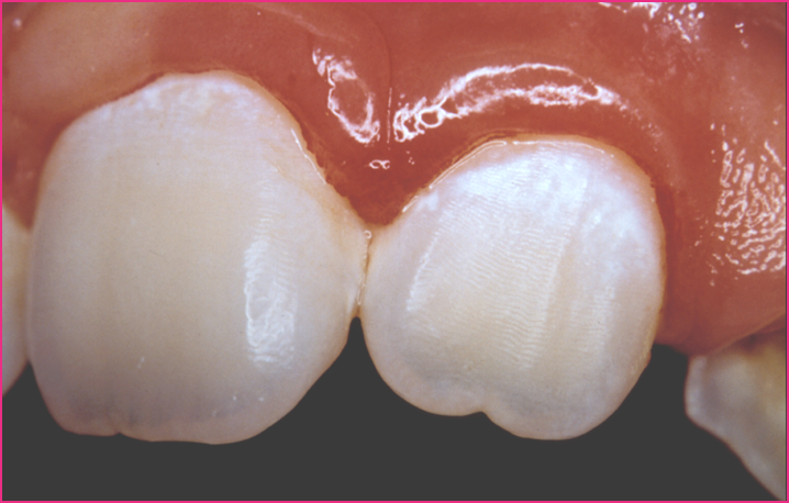 Coloração vermelho-vivo e sangramento ao escovar ou usar o fio dental podem ser indicativos de gengivite 