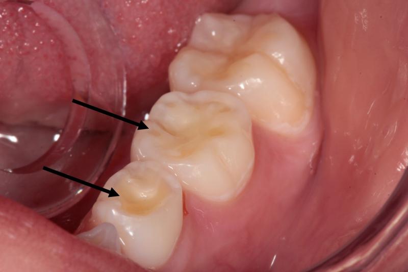 Desgastes da estrutura dentária (evidenciados pelas setas pretas) em decorrência da biocorrosão, gerando alteração na forma dos dentes