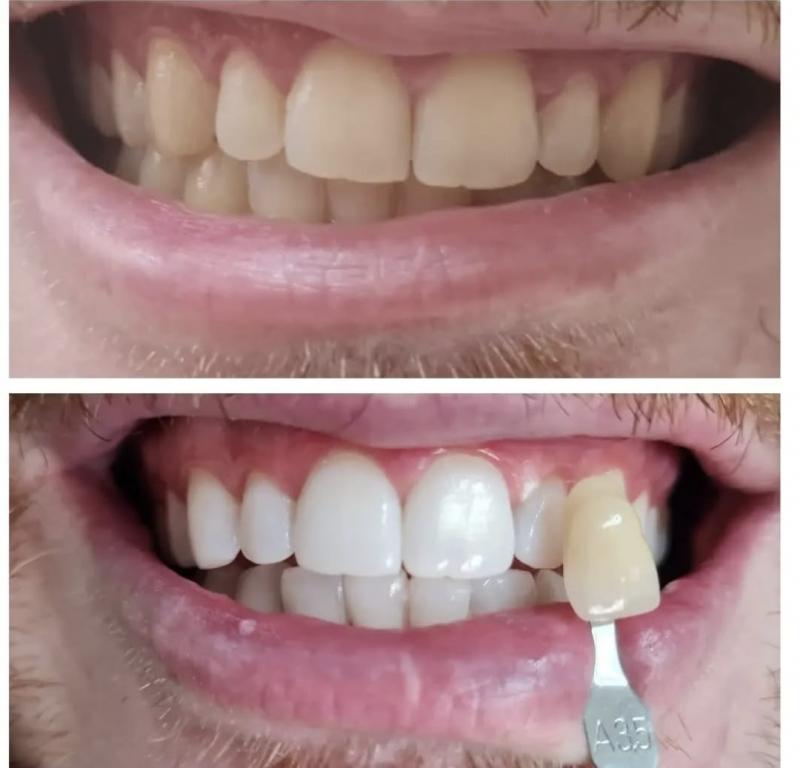  O antes e o depois do clareamento dentário