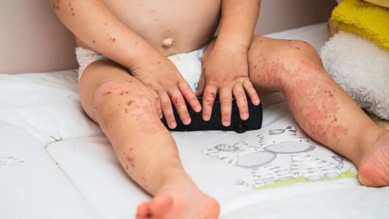 Prefeitura: principais sintomas são febre, mal-estar, falta de apetite, dor de garganta e erupções cutâneas