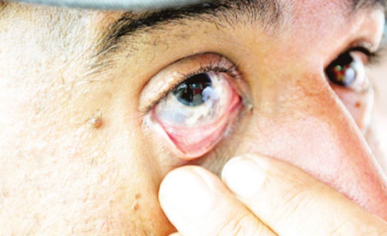Marcio Oliveira, Médico recomenda a limpeza das mãos antes de tocar os olhos para evitar a conjuntivite
