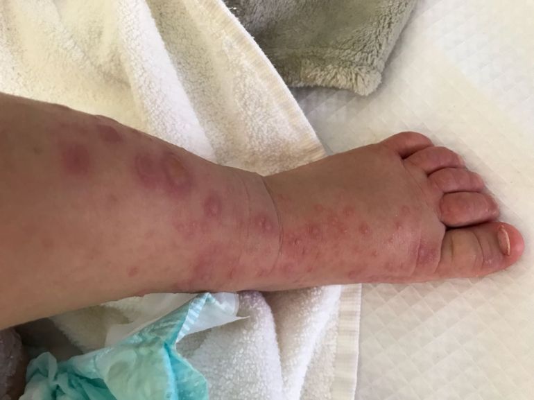 Cedida - Alguns dos sintomas são bolhas em mãos, pés e bocas, além de lesões avermelhadas